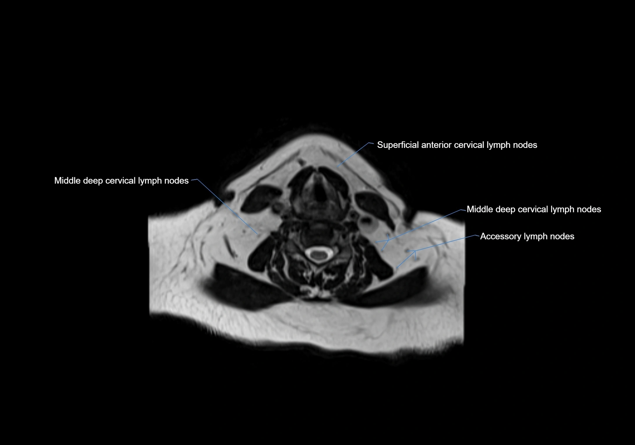 Neck axial  lymph node cross sectional MRI anatomy 3T MRI  image-img-00001-00064.webp